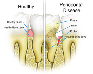 Failed dental implants