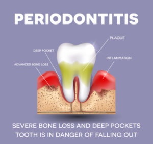 periodontitis-bone-loss