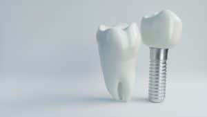 dental implants queens ny