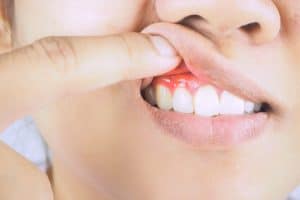 periodontal disease stages