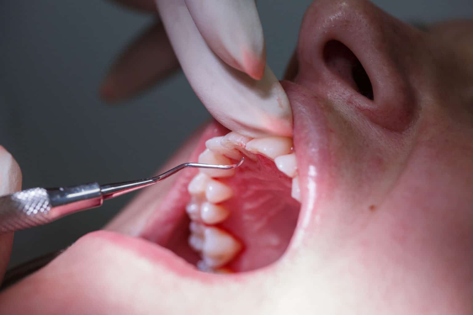 gum disease treatment at home